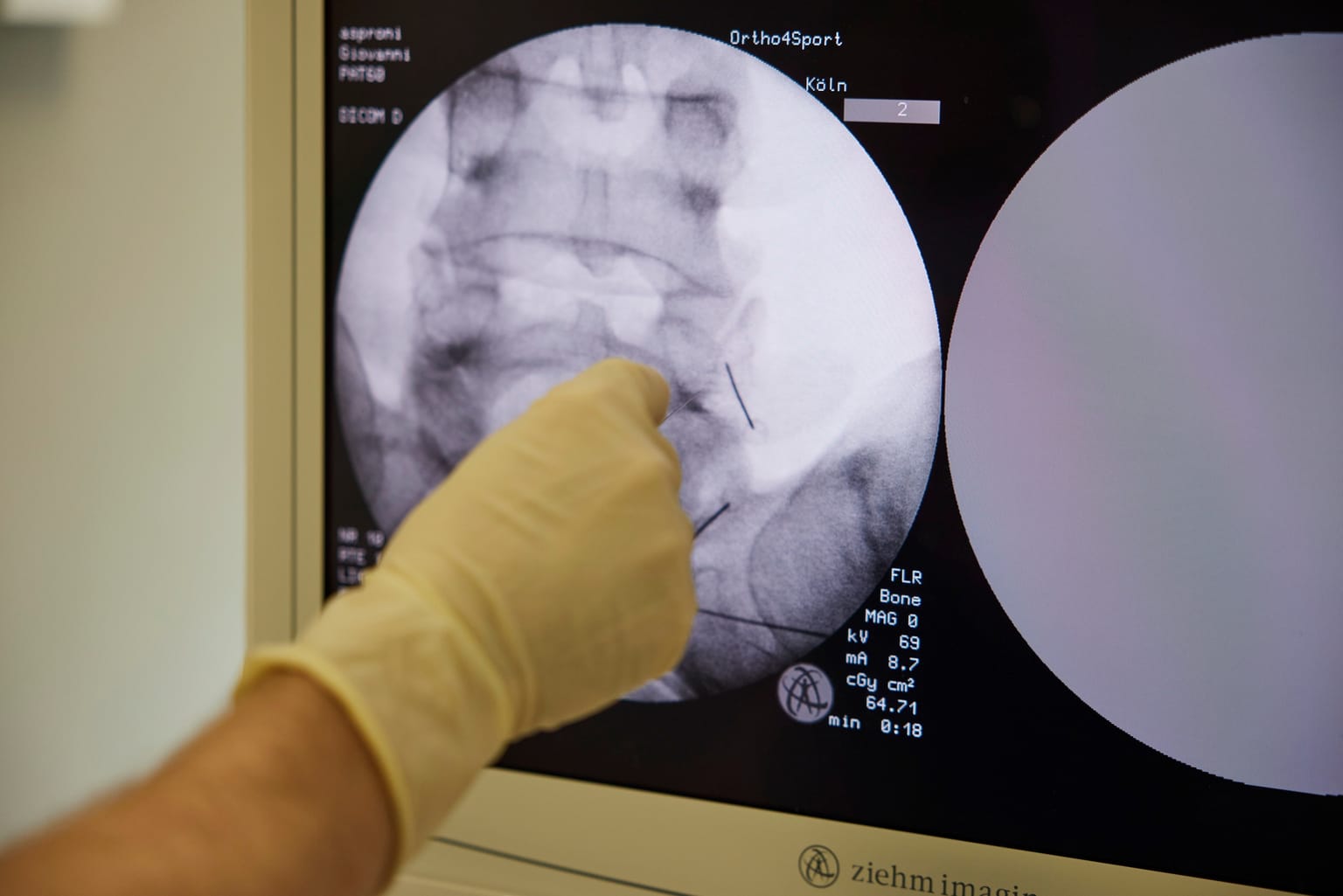 Multimodale Schmerztherapie — Präzise Schmerzbehandlung mit bildgeführter Technik